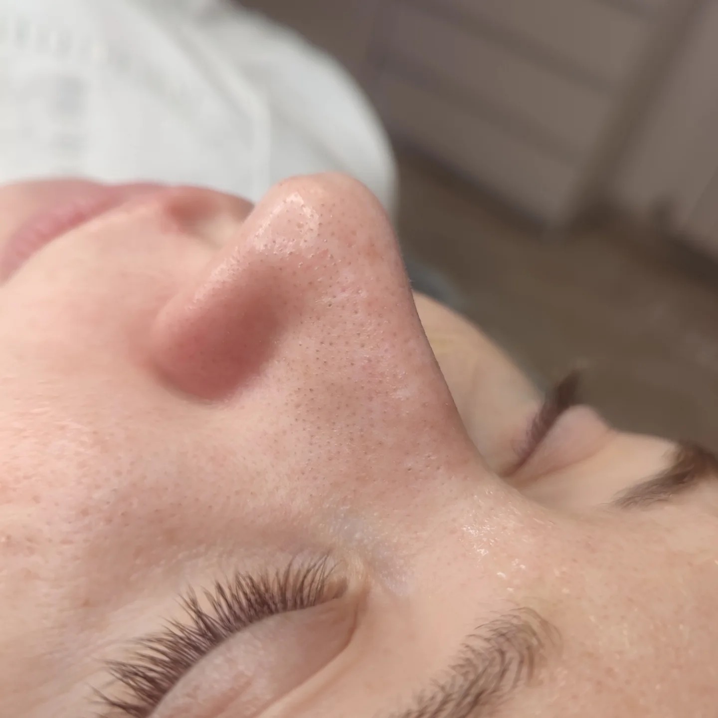 Обличчя до механічної чистки — косметолог Ангеліна Дарієнко Миколаїв